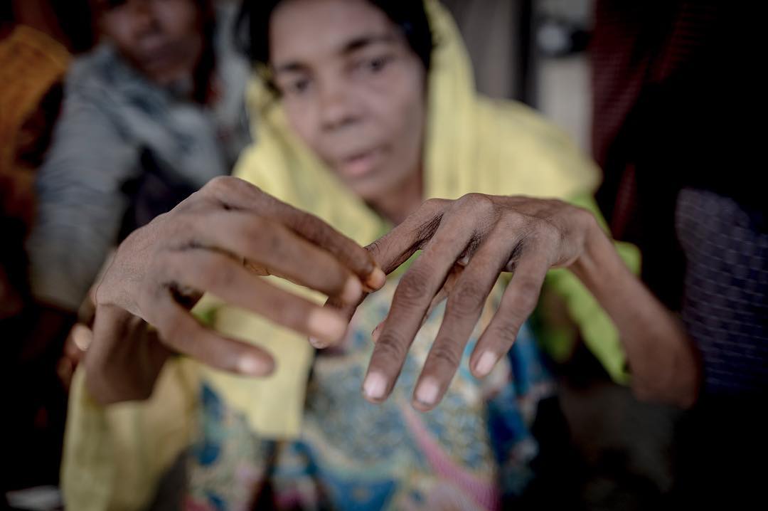 Amina, 65- shows where it hurts in her joints due to 19 days without food or water. She arrived at Shah Porir Dwip on a makeshift raft. They arrived during night and was beaten by local BGB Officer. “All who looked like an adult was beaten with a large stick”. Amina Arrived along with 24 others. They were stuck outside the Myanmar borderfence at Dhaonkhalia for 19 days, and having no money to pay the smugglers they collected bottles from the ocean over 7 days to make their raft and succesfully crossed. This is the second time Amina has fled her home to Bangladesh